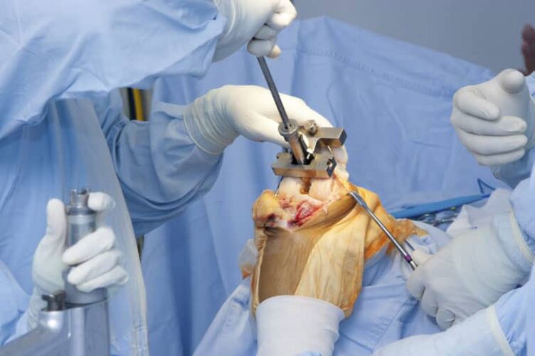 Chirurgie de osteoartrita la genunchi