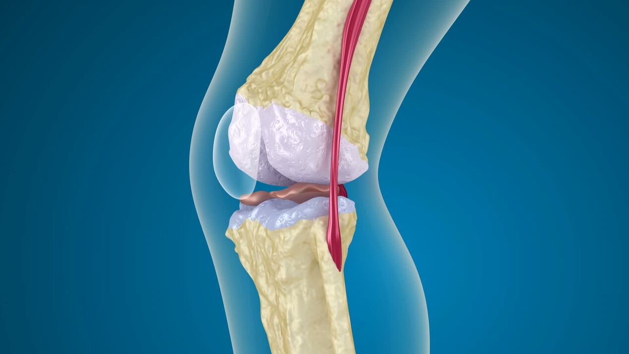 Distrugerea articulației genunchiului în osteoartrita