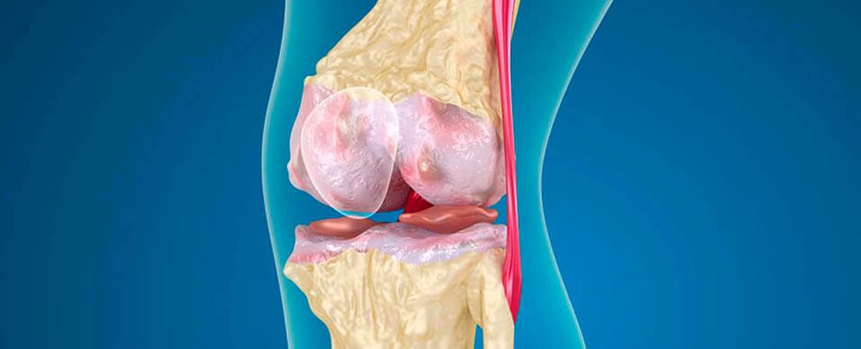 Osteoartrita genunchiului ca cauză a durerii