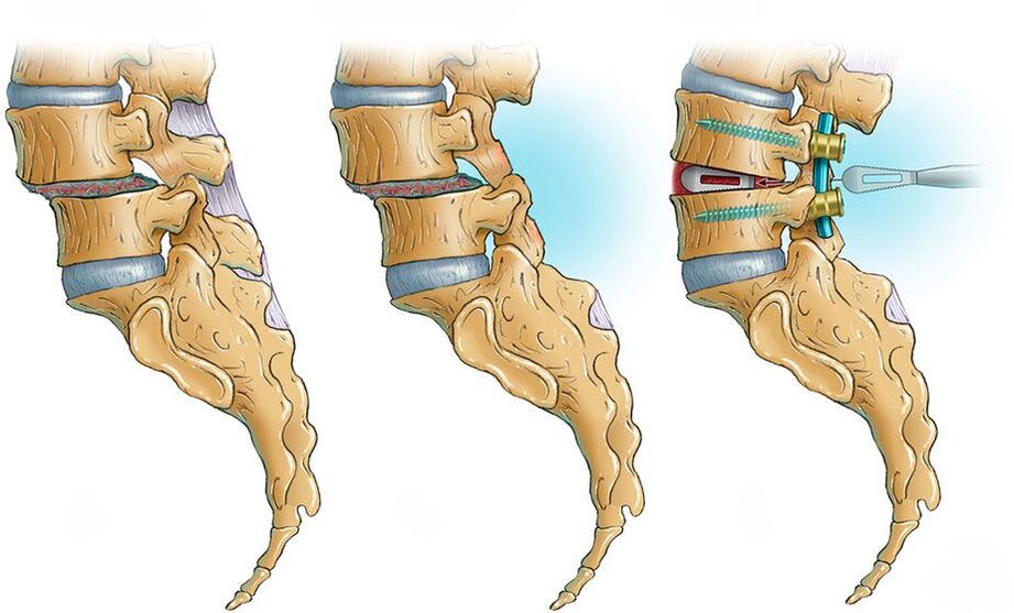 Deformarea coloanei vertebrale