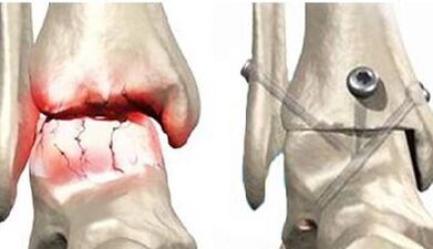 Tratamentul chirurgical al osteoartritei la genunchi