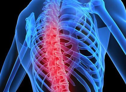 Osteocondroza coloanei vertebrale toracice