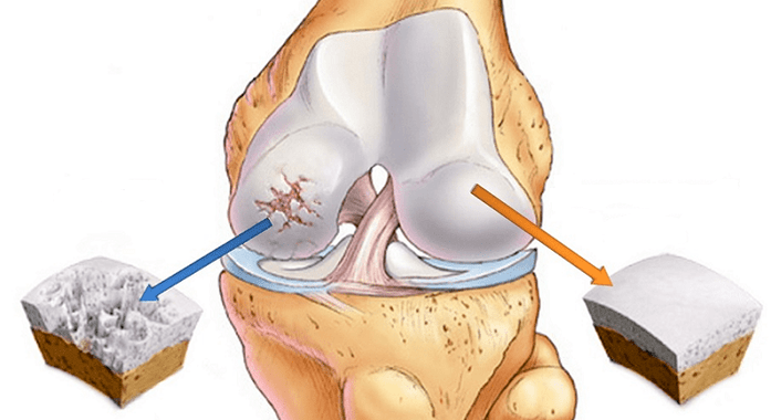 cartilaj sănătos afectat de osteoartrită