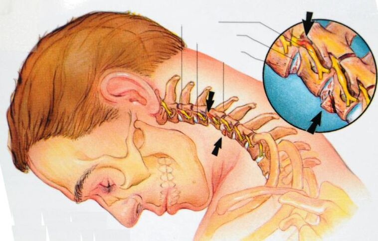 Ce se întâmplă cu osteocondroza cervicală