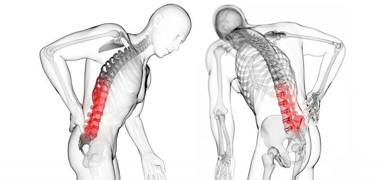 Complicațiile osteocondrozei cervicale