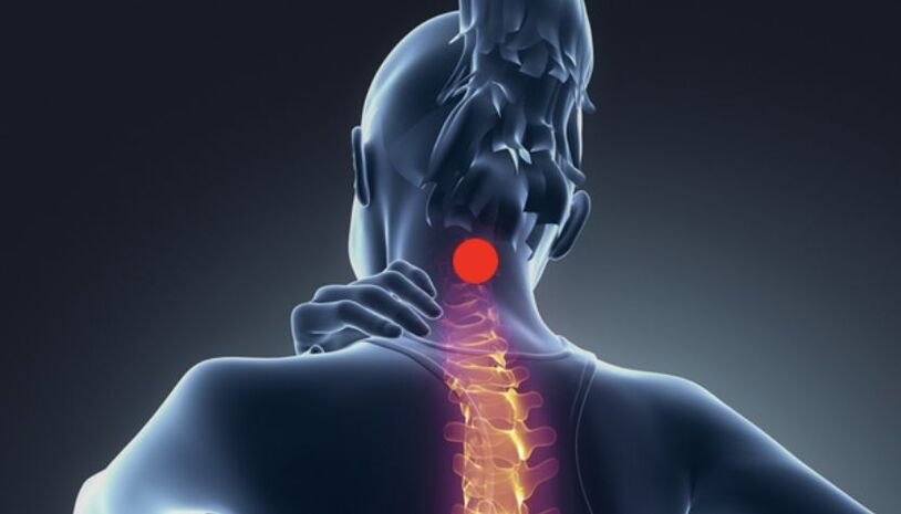 Simptomele osteocondrozei cervicale