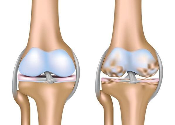 Osteoartrita