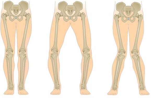 Tipuri de osteoartrita