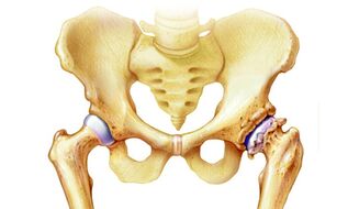 de ce apare osteoartrita articulației șoldului